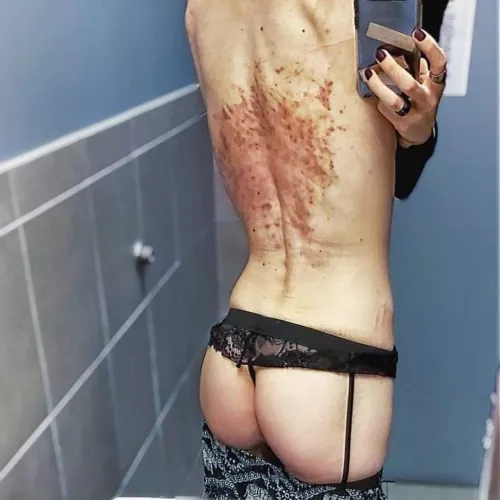 300 lashings and 24 hours later... it's still warm to the touch. sensitive and sore but looks much worse than it actually feels.