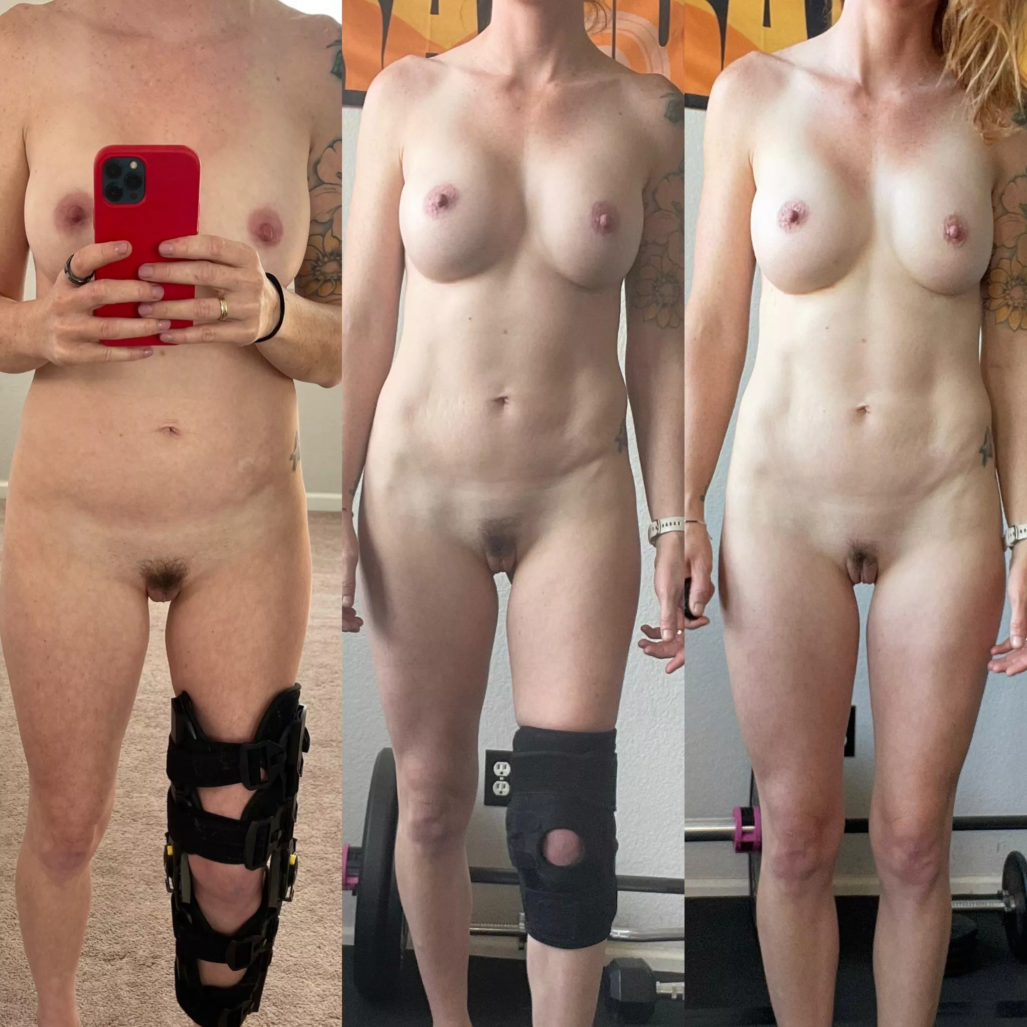 A different OnOff today. Broke my leg and here is my progress to being brace free!! (F33)