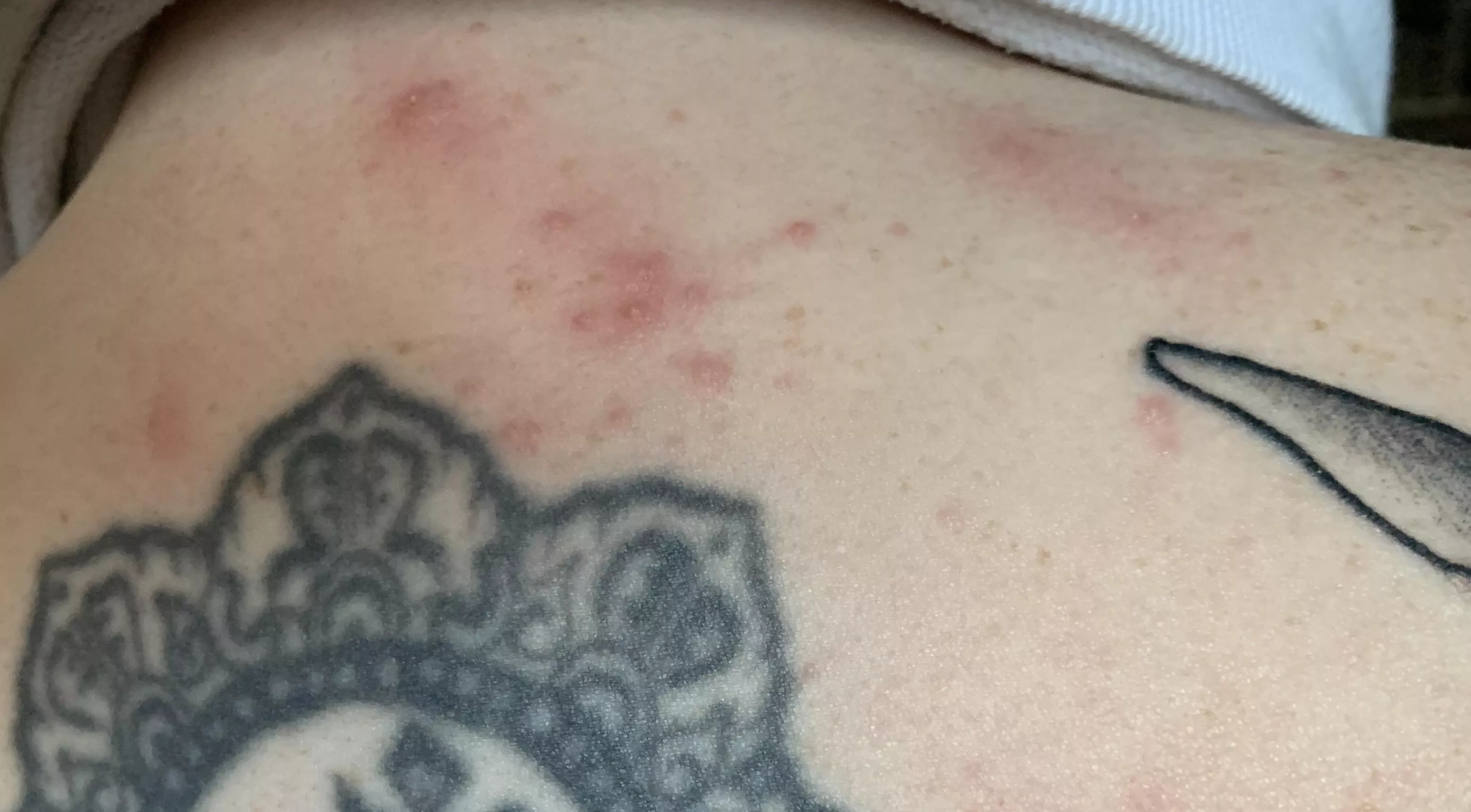 Allergic reaction to saniderm after getting tattooed …. and my partner refuses to pop the whiteheads for me