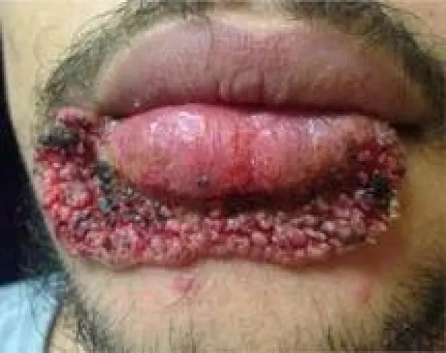 Always use clean tools! Credit to r/medicalgore, for some reason I couldn't xpost.