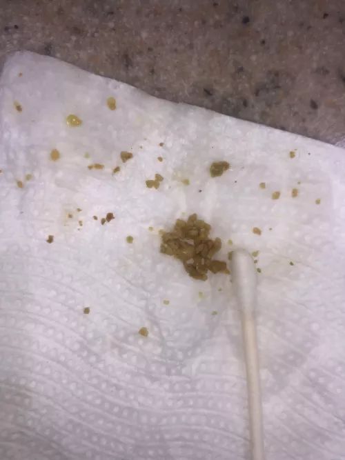 And the stones are still coming out 🤮