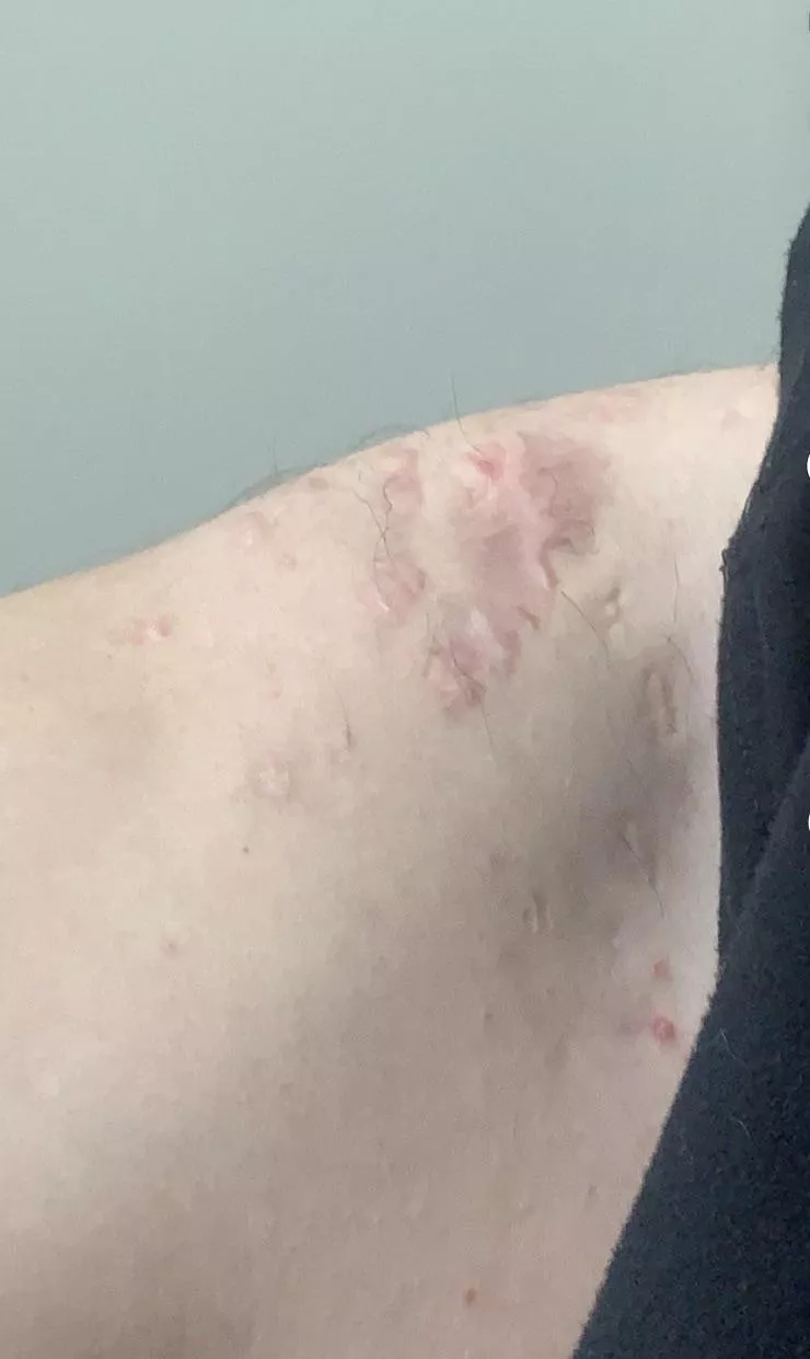 Anyone know how to get rid of some cystic acne scars, and cysts. I got them worse on my back Anyone know how to get rid of some cystic acne scars, and cysts. I got them worse on my back