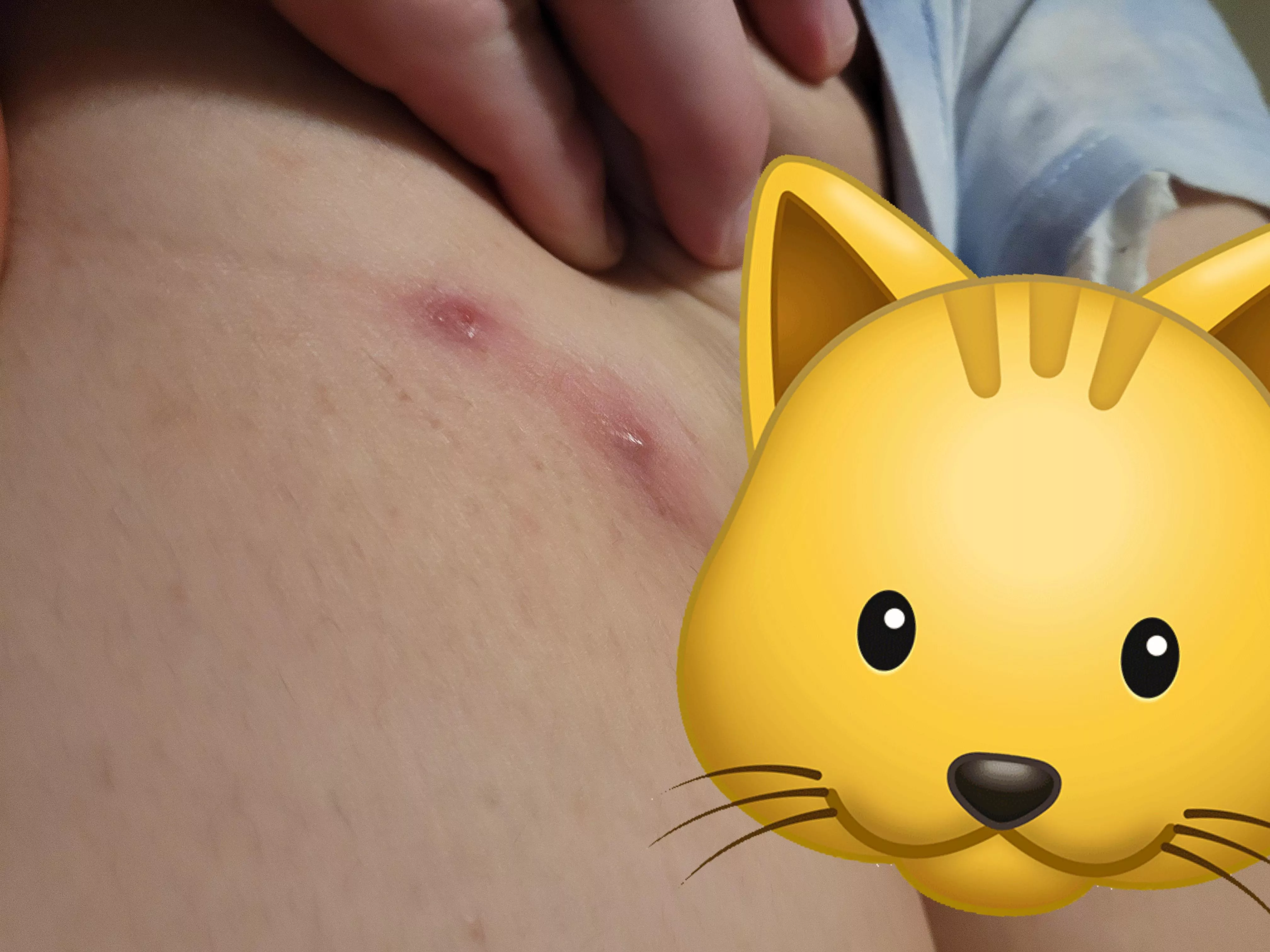 been a lurker for a while. found these last night under by buttcheek, the pop was painful.