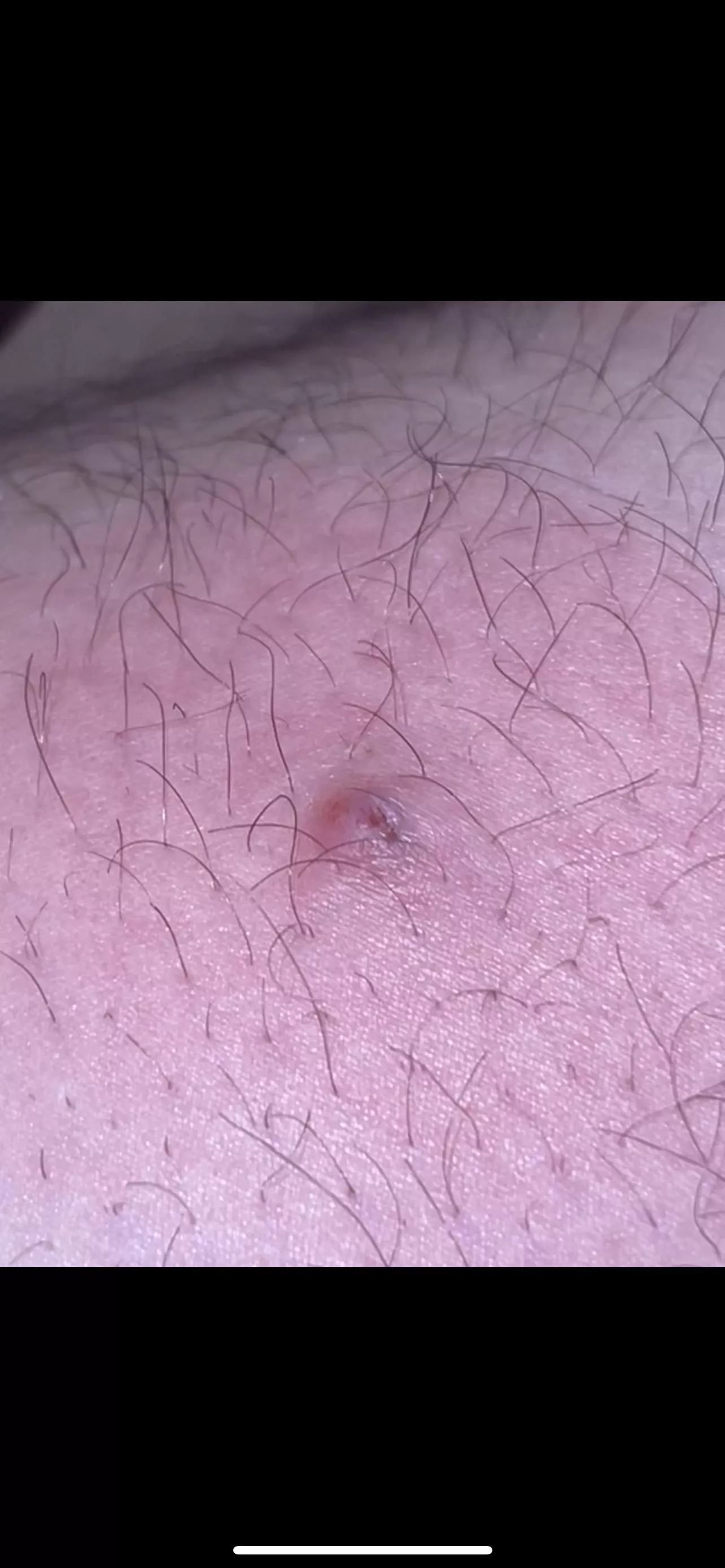 Before I rush to ER is this a spider bite or an ingrown hair? Hurts pretty darn bad.