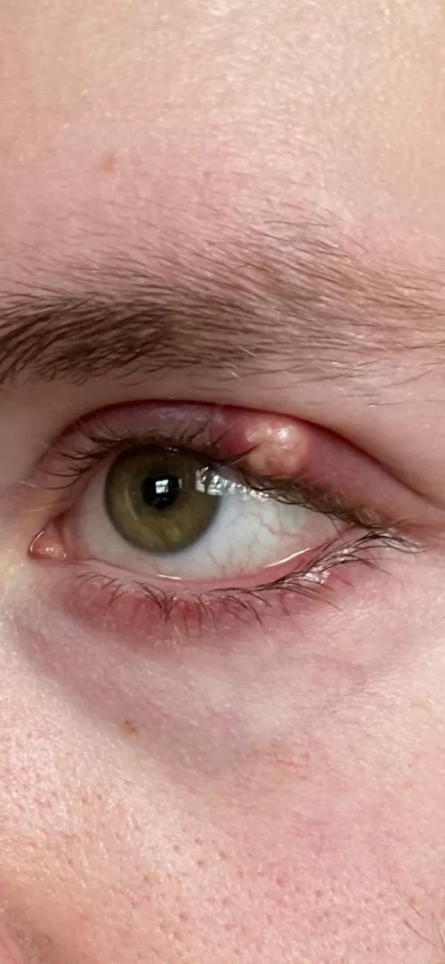 Biggest stye I’ve ever had I’m trying to fight the urge to drain it myself