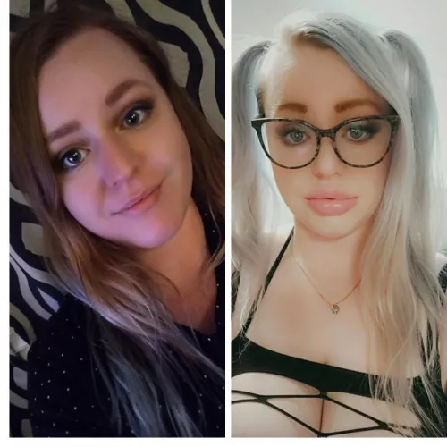 Botox, 6ml of lip filler, 1 ml to round my chin. One year apart, still so much progress to be made but starting to feel like a bimbo! ???