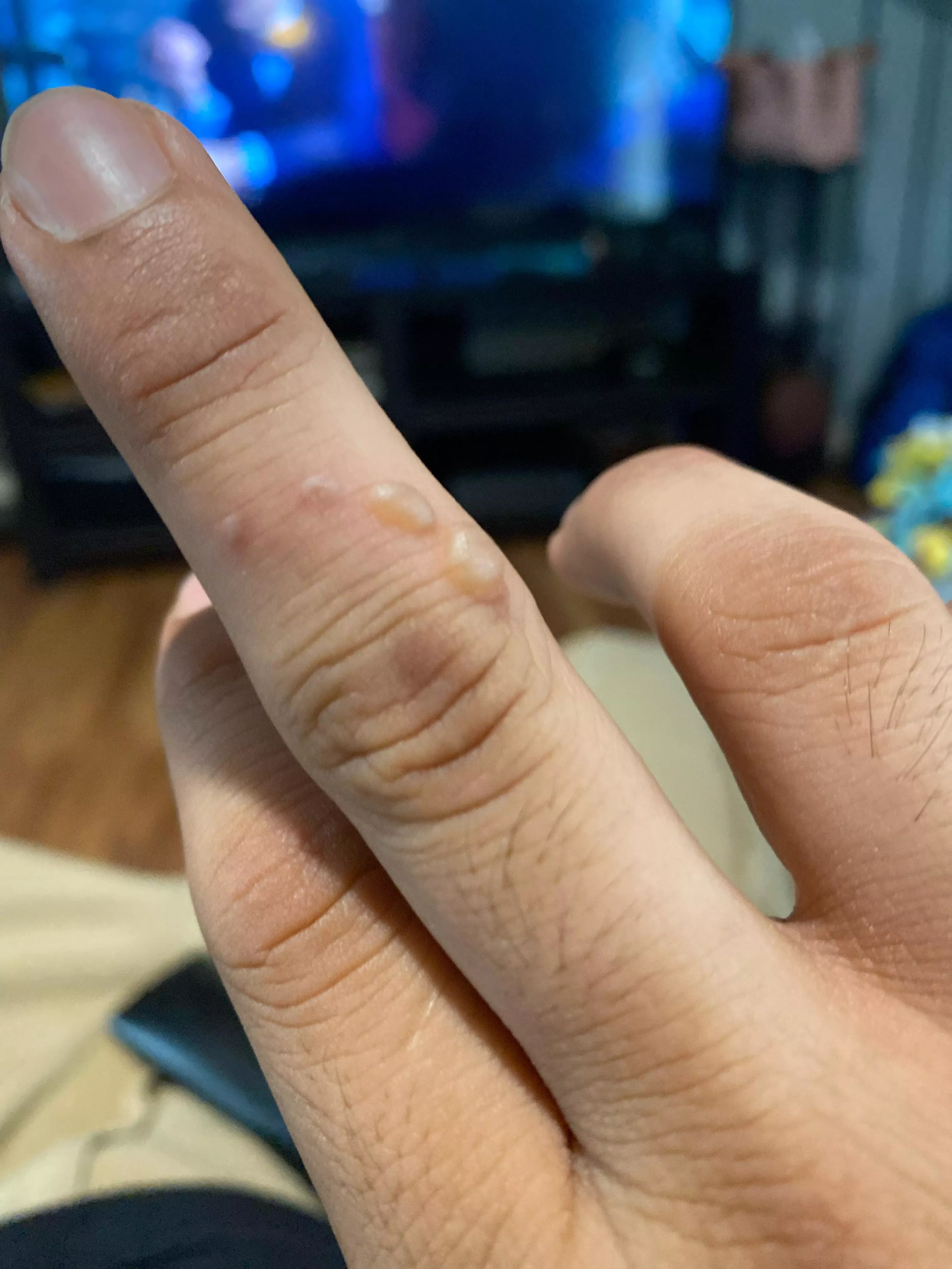 Burned myself with melting plastic Burned myself with melting plastic