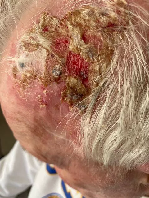 Dad had to apply some cream to burn off pre-cancerous cells and had a major reaction. Dad had to apply some cream to burn off pre-cancerous cells and had a major reaction.