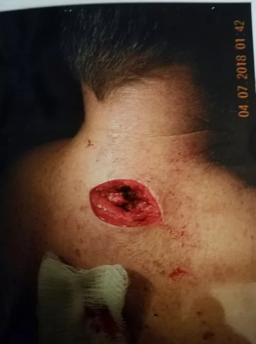 Dad’s lipoma removal