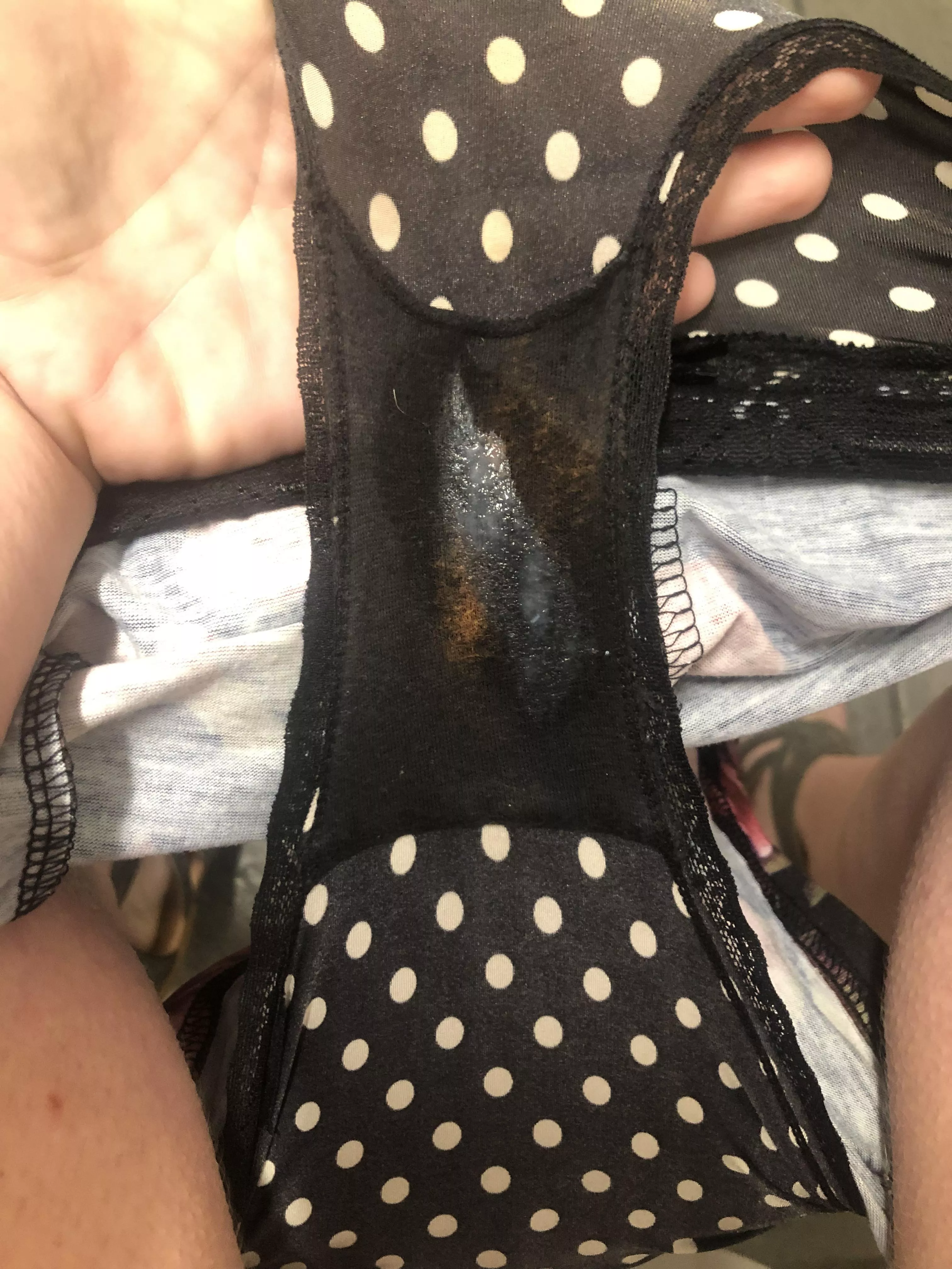 Day one with some prior discoloration due to ph