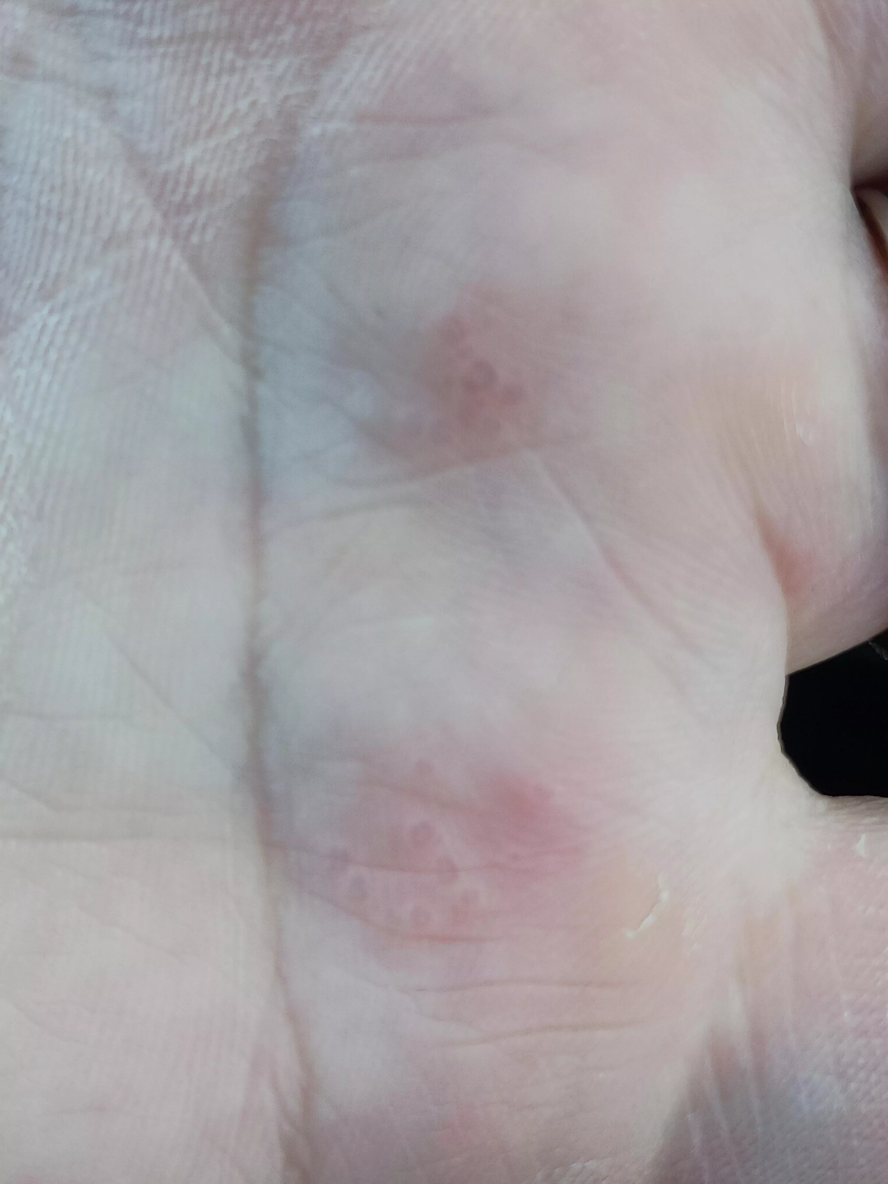 dyshidrotic eczema flare. popped up overnight. It comes out when I'm stressed. dyshidrotic eczema flare. popped up overnight. It comes out when I'm stressed.