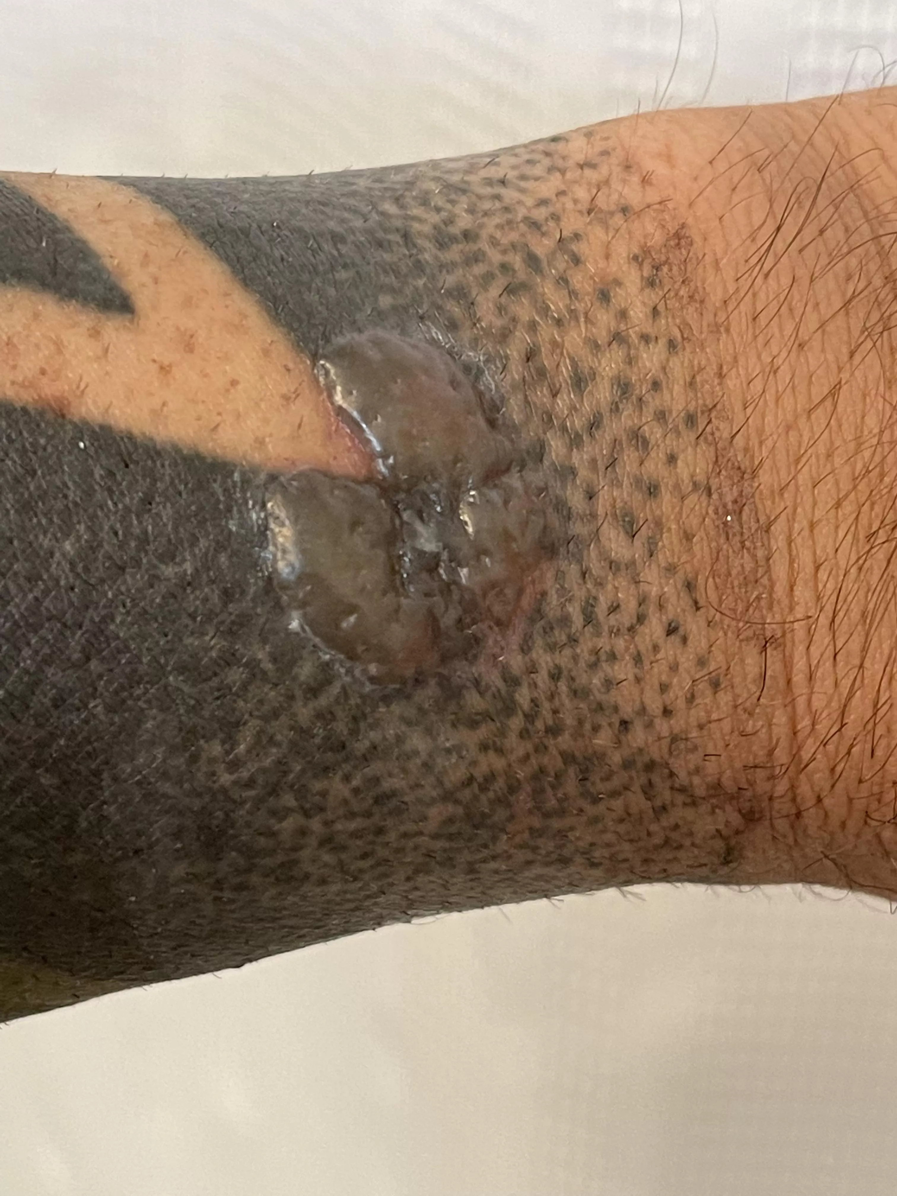 Forbidden blood blister from laser tattoo removal. Taking forever to heal.