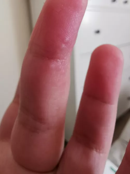 Forbidden pop, dyshidrotic eczema.