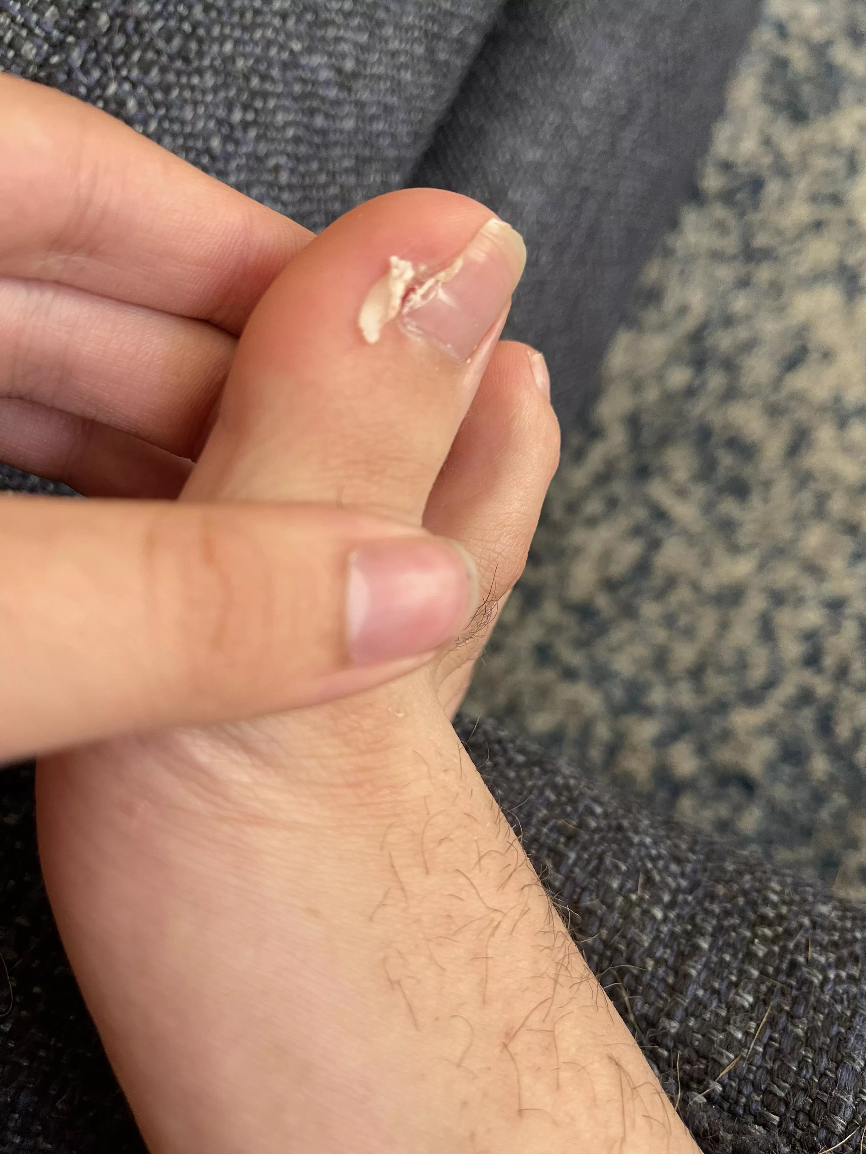 Got ingrown removed a few months ago. Think they missed a piece and I pulled it out.