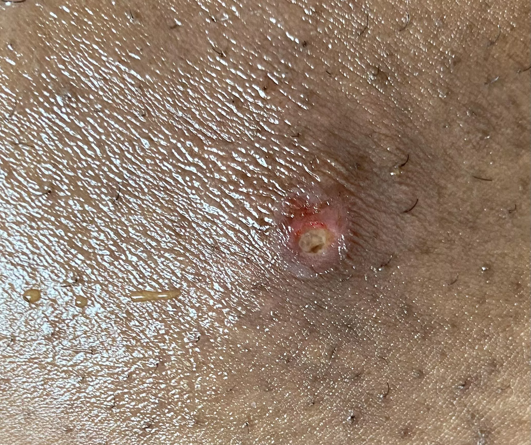 Had a somewhat large boil that popped while I was sleeping now it looks like this. Should I be worried?