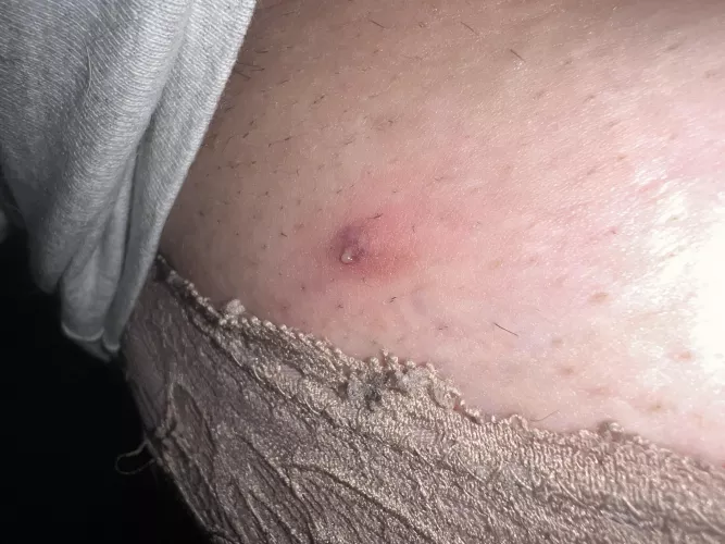 had this weird thing under my arm. popped it earlier. it’s been hurting all day, checked it and this is what it looked like!! ew.