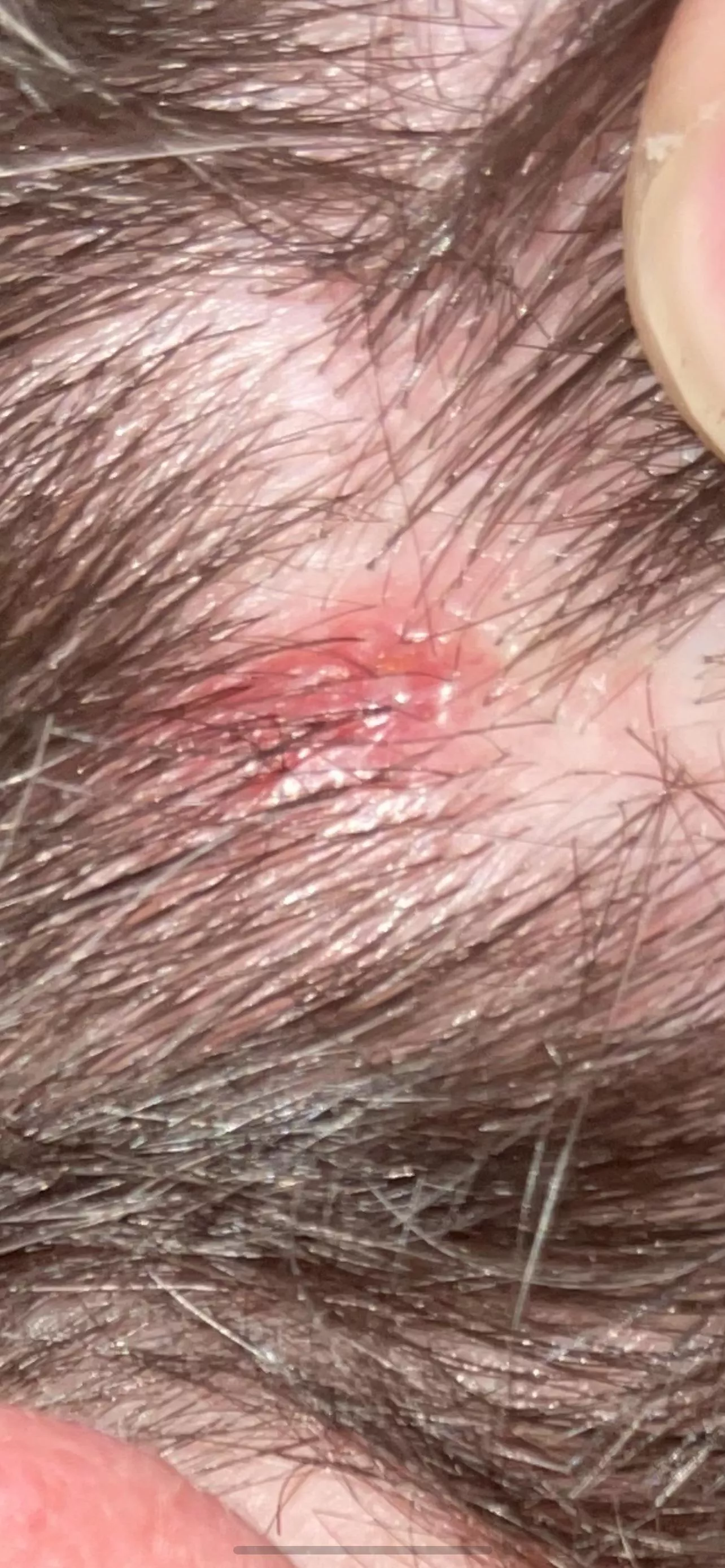 Hair line, anyone know if it’s an ingrown hair or a pimple?