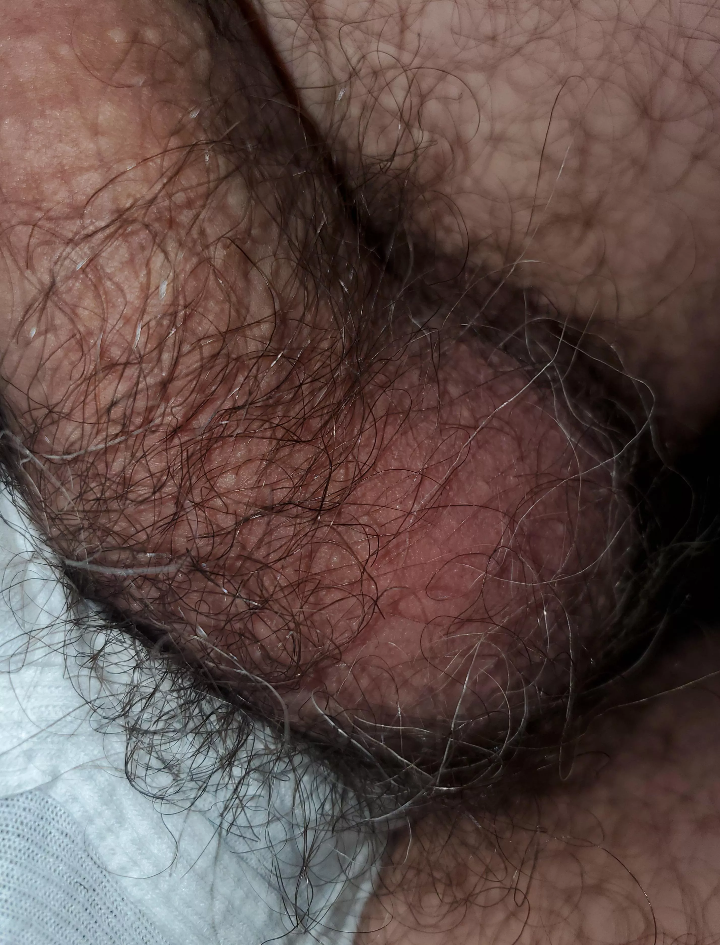 Hairy balls
