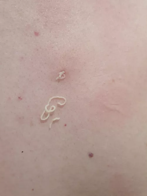 Husband's cyst refilled, what a treat