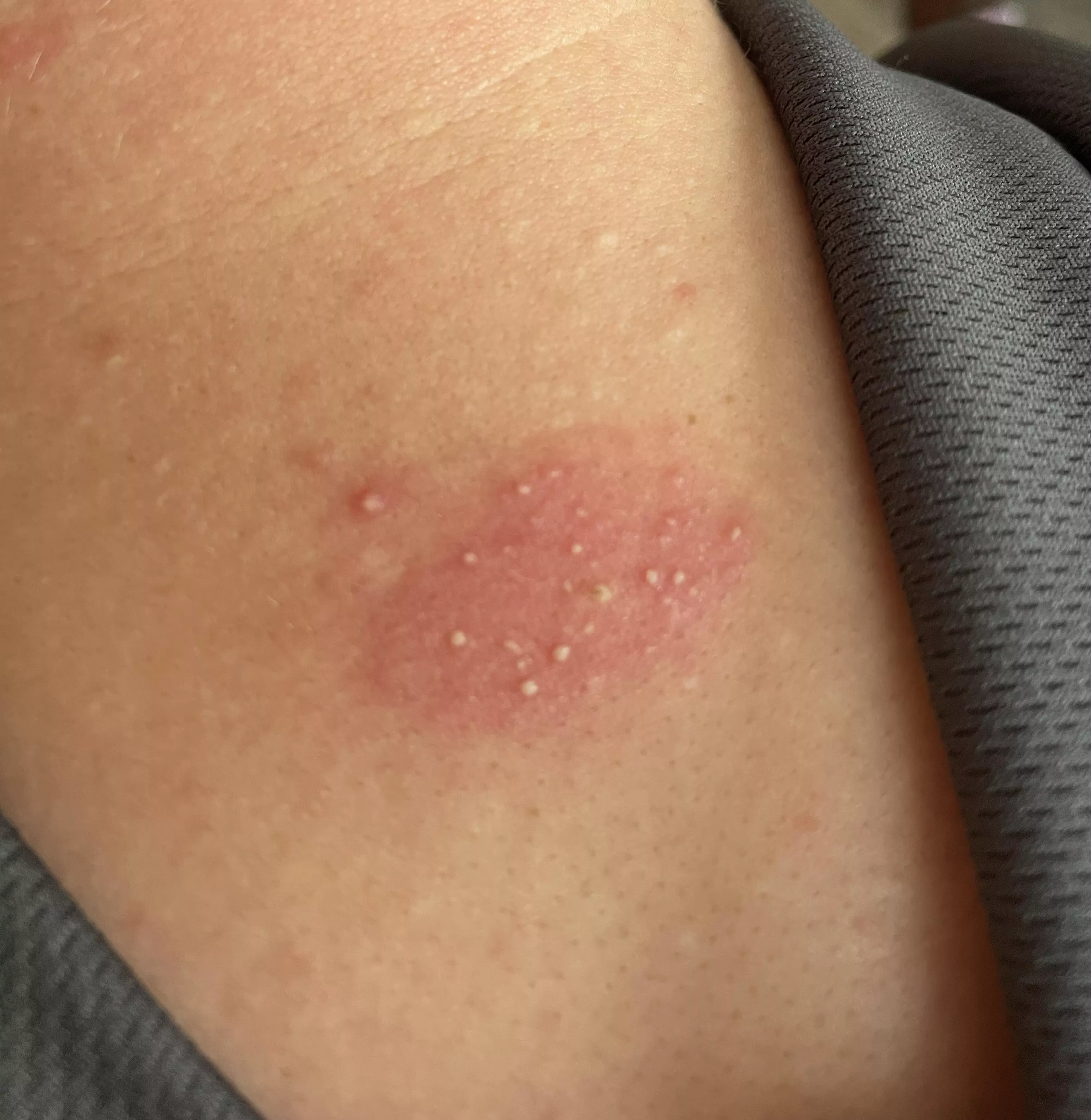I don’t know what caused this. Bug bite? Want to pop.