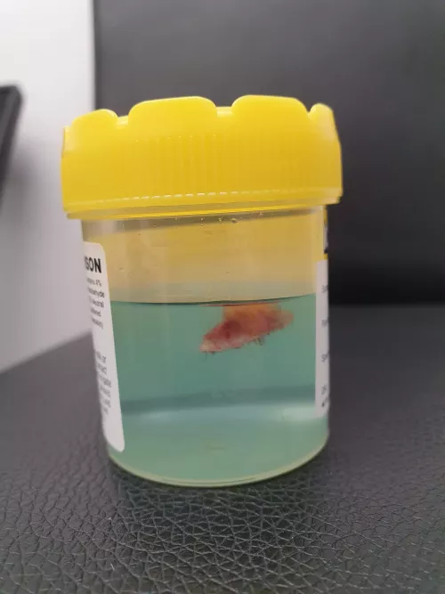 I had a sebaceous cyst cut out of my scalp yesterday.