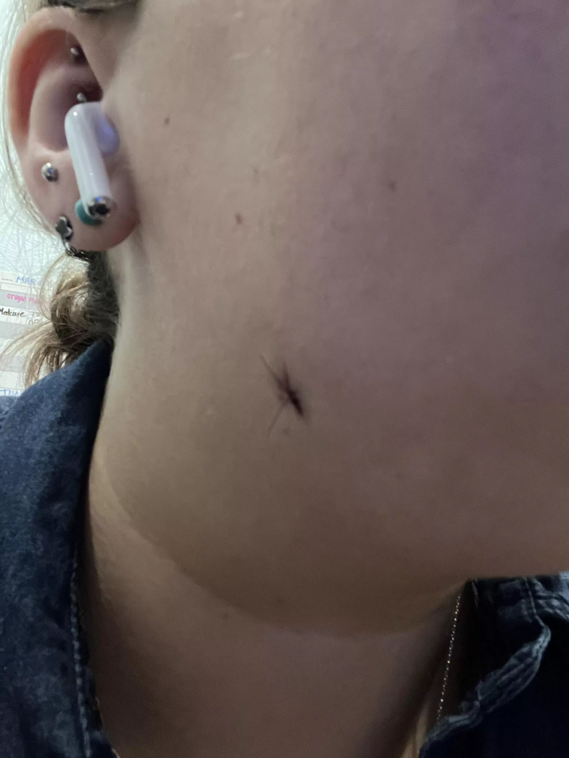 I just wanted to give a little update that I was finally able to have my cyst removed. It’s very itchy right now but I’m very glad it’s been done. Also, before you tell me to put some kind of bandage on it I’m extremely allergic to adhesive and w