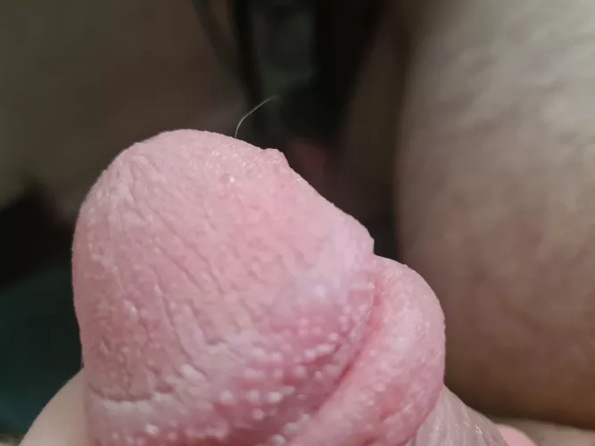 I never before had blisters on my head after pumping but now I have a lot why is that can someone help me out ?
