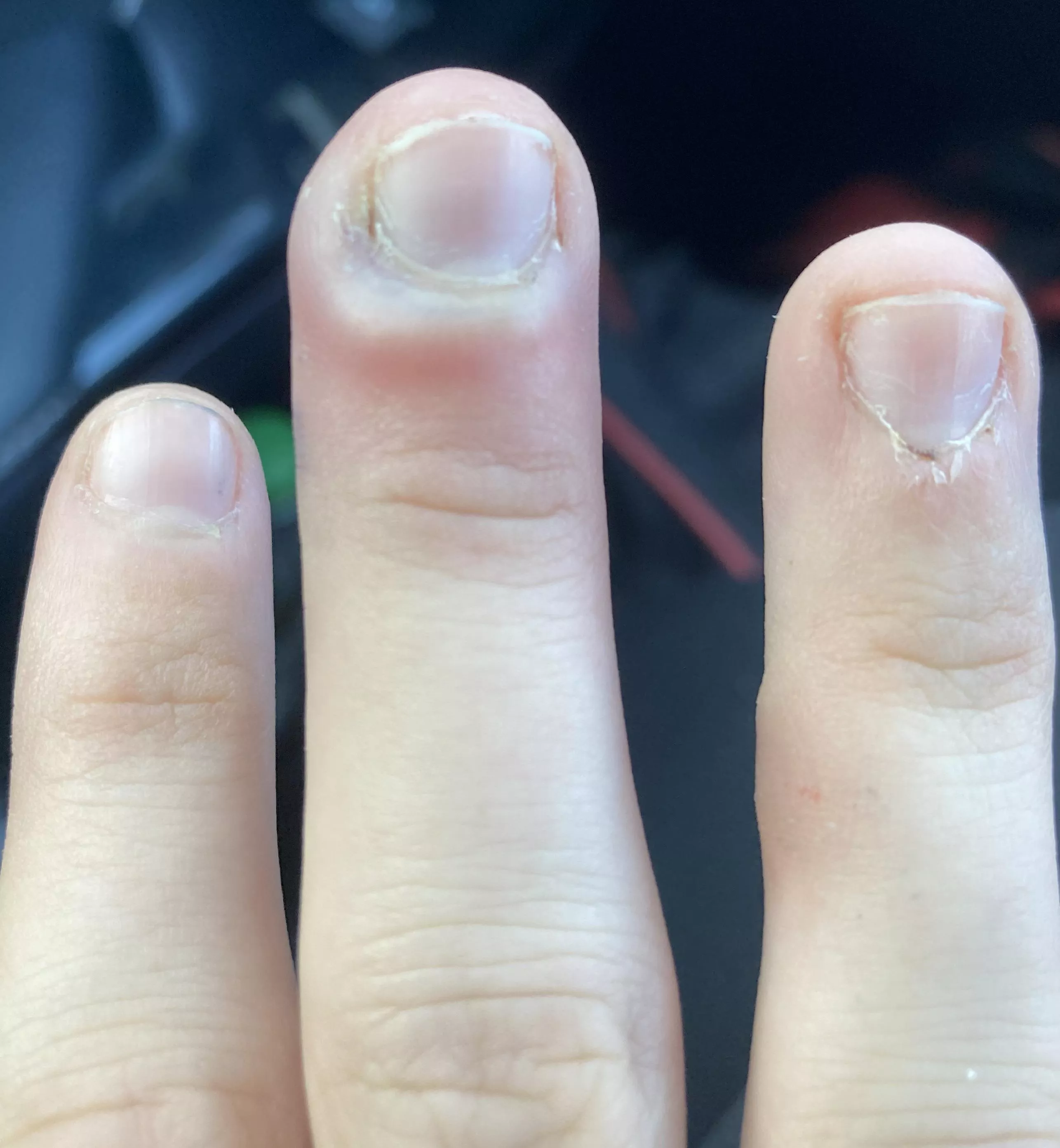 Infected finger, what should I do?