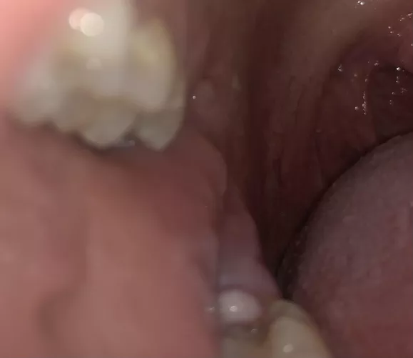 Infected operculum - pericoronitis. An infected flap of gums that falls across the molar. It hurts like hell. On antibiotics. I apologize for nothing.