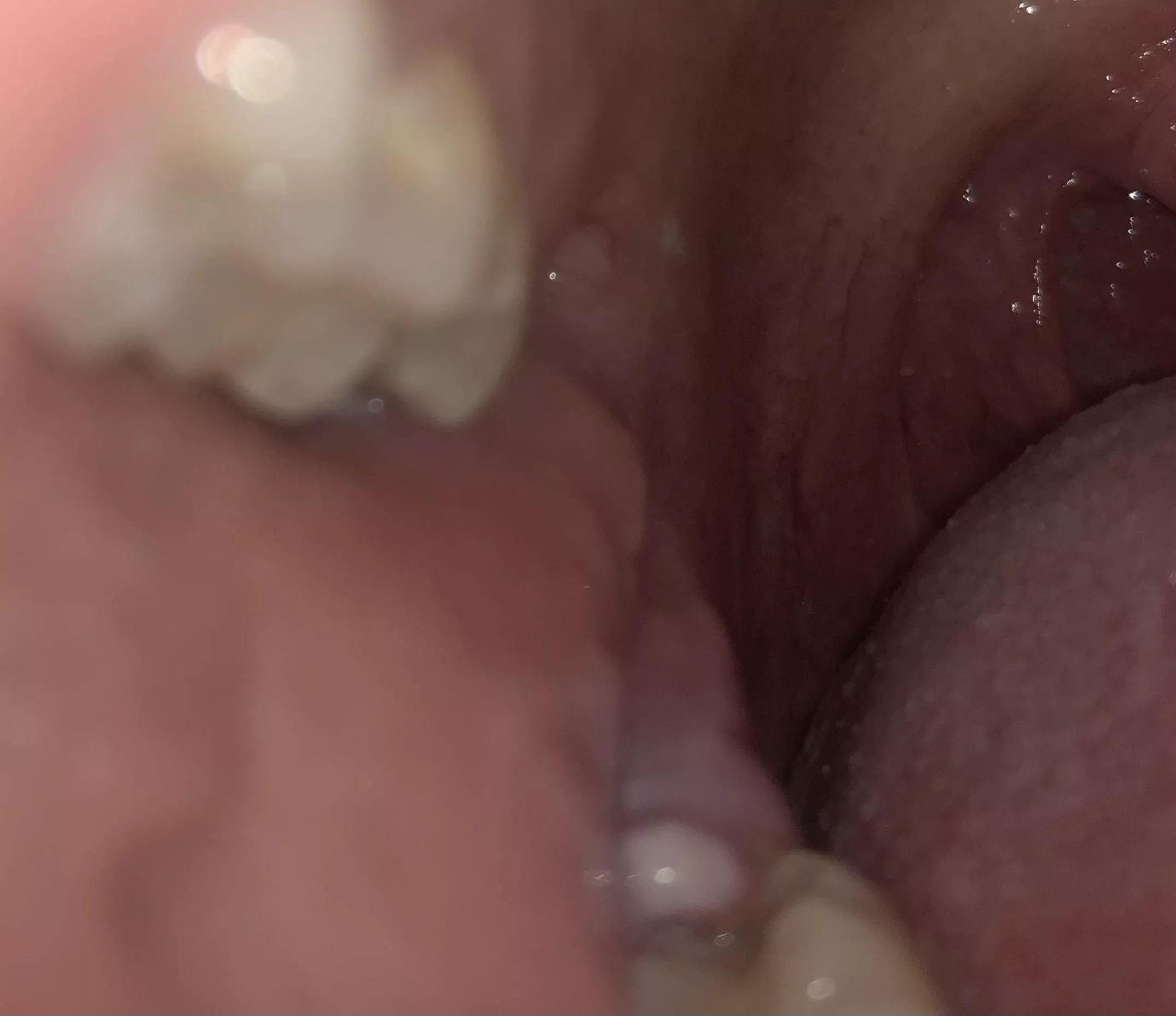 Infected operculum - pericoronitis. An infected flap of gums that falls across the molar. It hurts like hell. On antibiotics. I apologize for nothing.