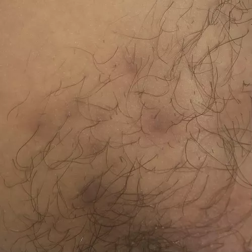 Ingrown hairs, boils, or cysts? Appeared after shaving, caused by chafing from wearing pads. Feel like pea sized hard lumps beneath skin. More info in comments