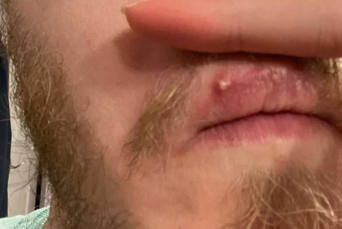 It popped on its own. He wouldn't let me touch it 😭