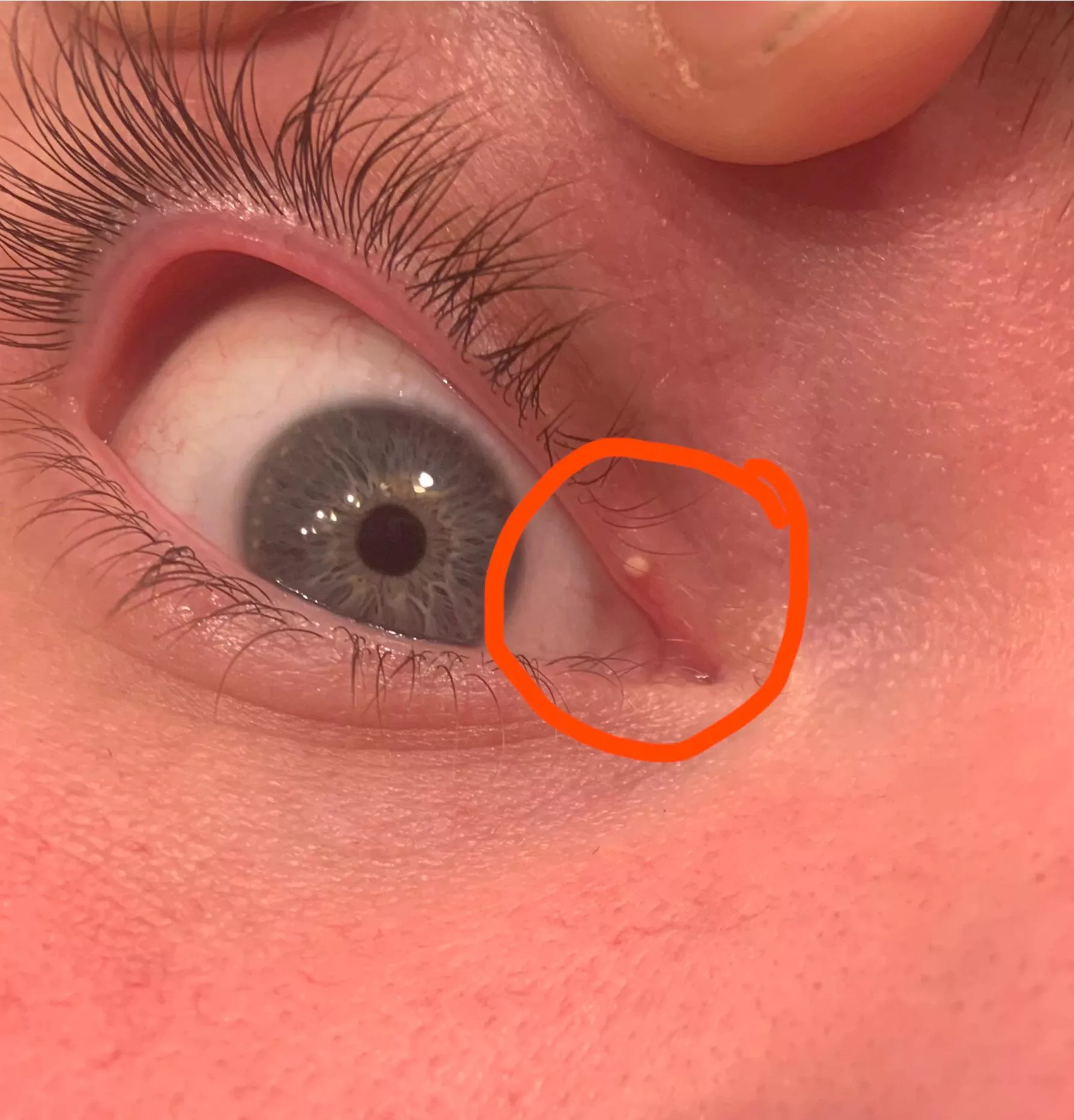 I’ve had this on my eye for over two years now. Do I pop it or leave it? What exactly is it?