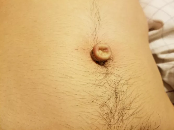 My belly button turned into an outie with a rubber band. 😃