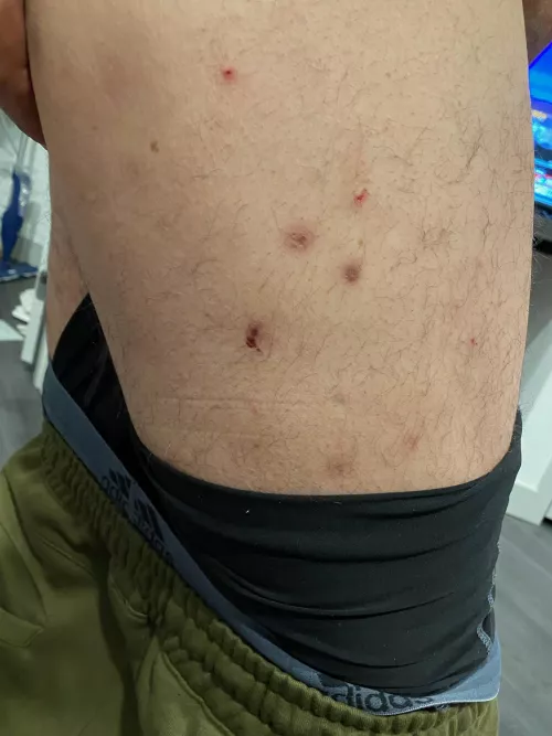 my crps blisters. They usually have a hard core in the middle.