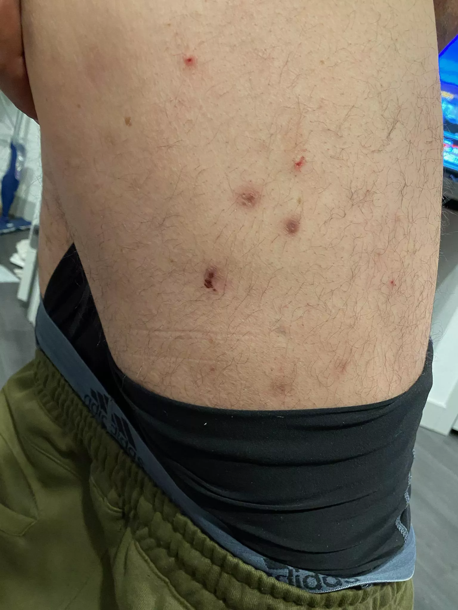 my crps blisters. They usually have a hard core in the middle.