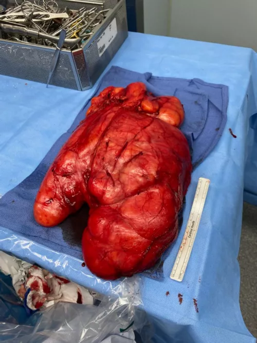 My Dads 13lb Lipoma taken from his leg in 2020. It was benign and he's able to walk like normal!