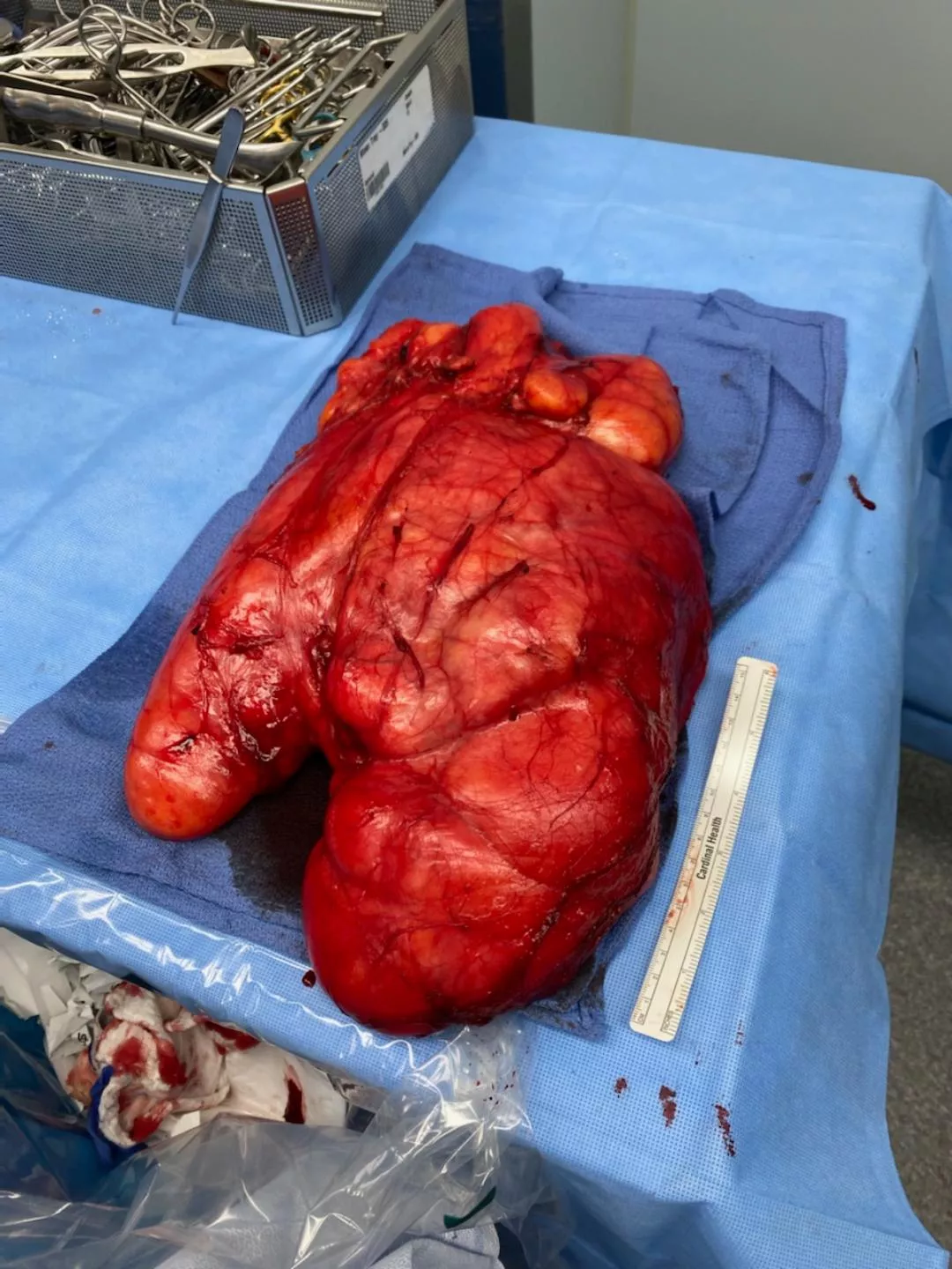 My Dads 13lb Lipoma taken from his leg in 2020. It was benign and he's able to walk like normal! My Dads 13lb Lipoma taken from his leg in 2020. It was benign and he's able to walk like normal!