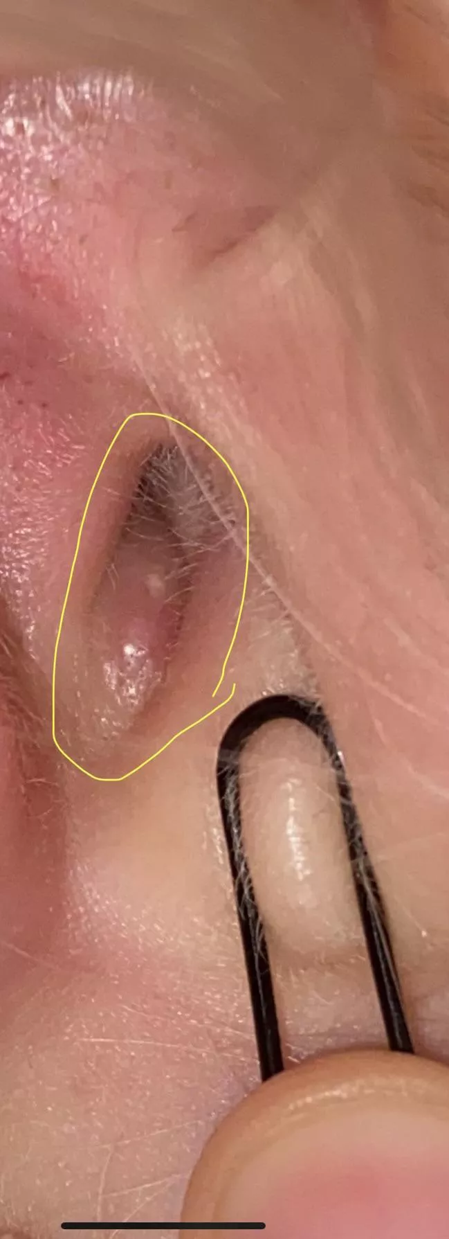 My ear. Not a video but this must be one of the worst places to get pimples. It hurts so bad to squeeze it I can’t get it out 😭 just straight up sitting in my ear canal