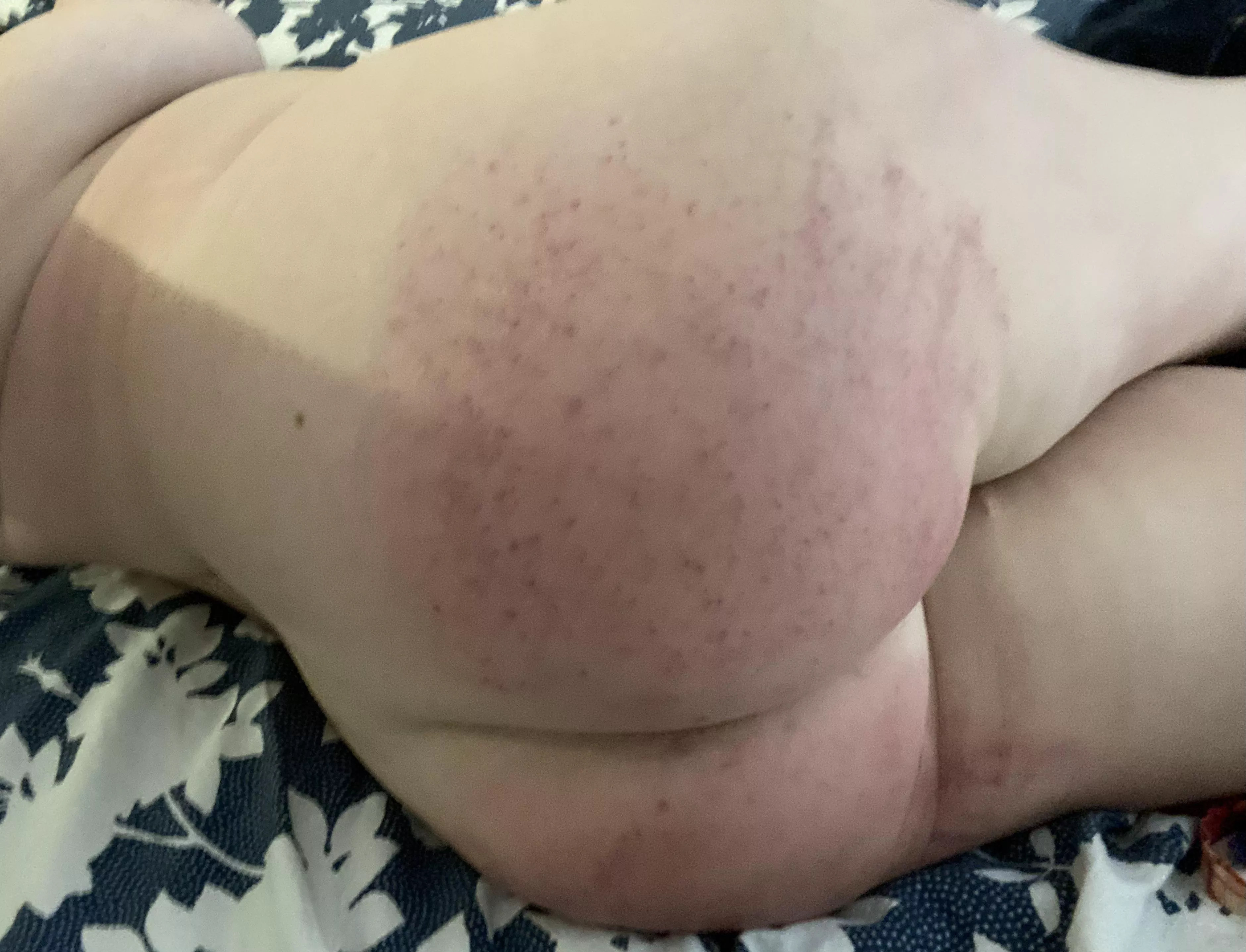My freshly spanked bottom. Sore and blistered :)