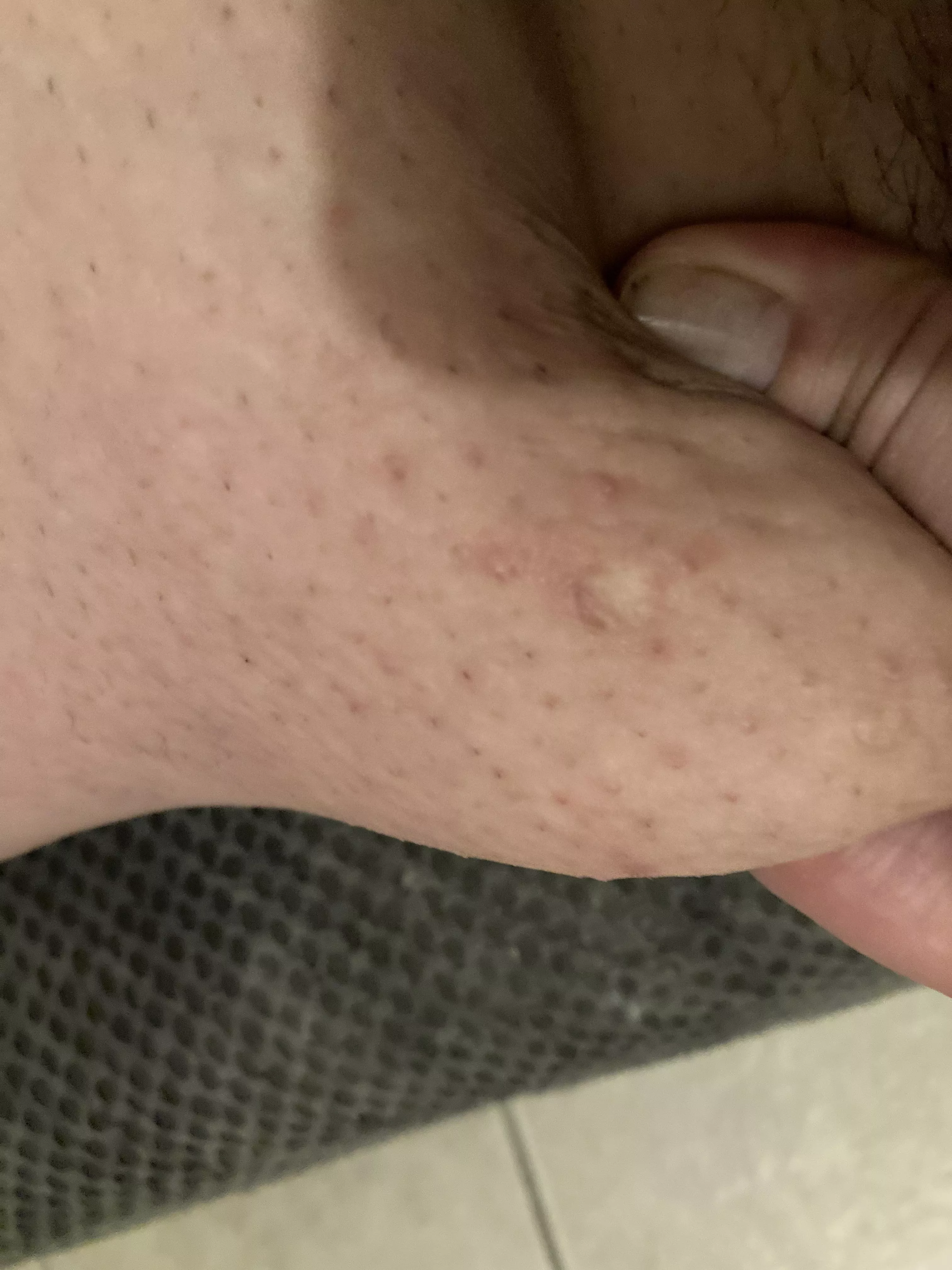 Need advice please. This is a pic of a portion of my upper thigh. My inner thighs are like this all over. I don’t know who can help or what I should do. Dermatologist? Self help? Salon? Been like this my entire adult life and I’m so self conscious ab