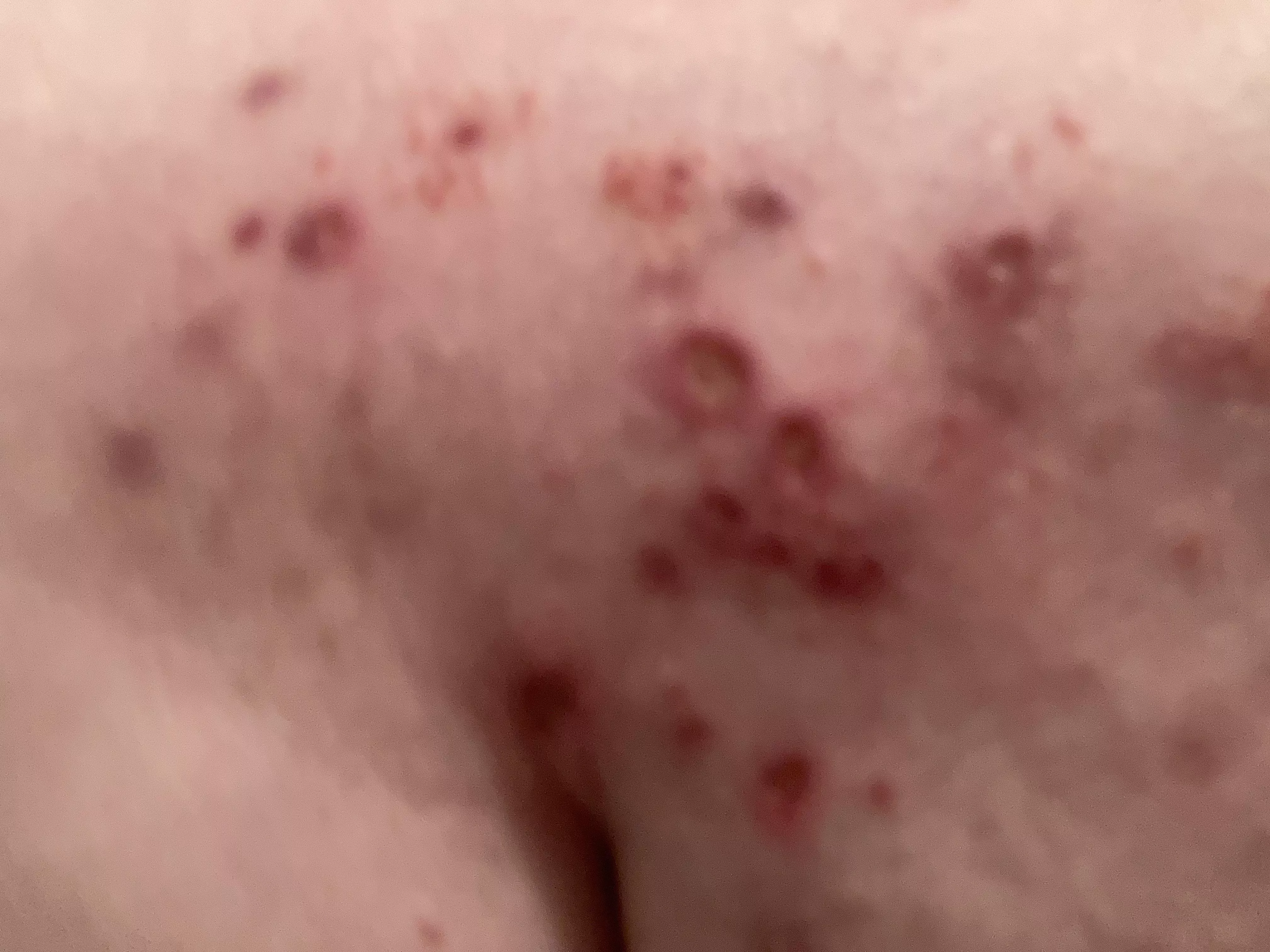 Nfsw my butt, the damage to my back from adhesive. This is the nasty open sore level damage my back has from adhesive. Unfortunately my insurance is refusing the liquid medication topical despite the obvious need to avoid the adhesive.