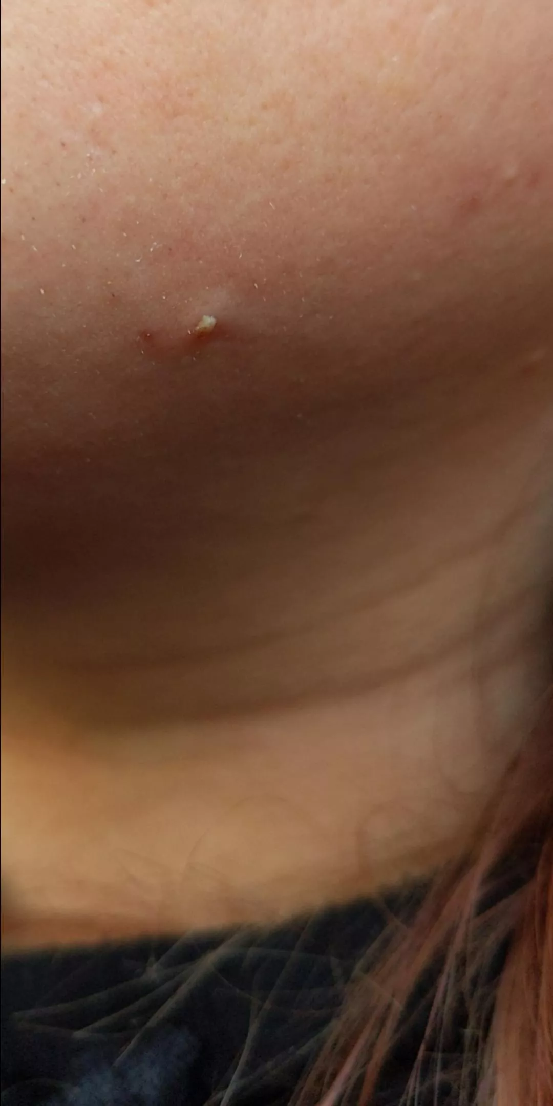 Nice big white head on my jaw, possibly an ingrown hair, get plenty of these thanks to PCOS.