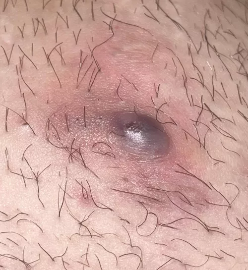 not sure what to do about this.. used warm compress and now looks like its ready to blow