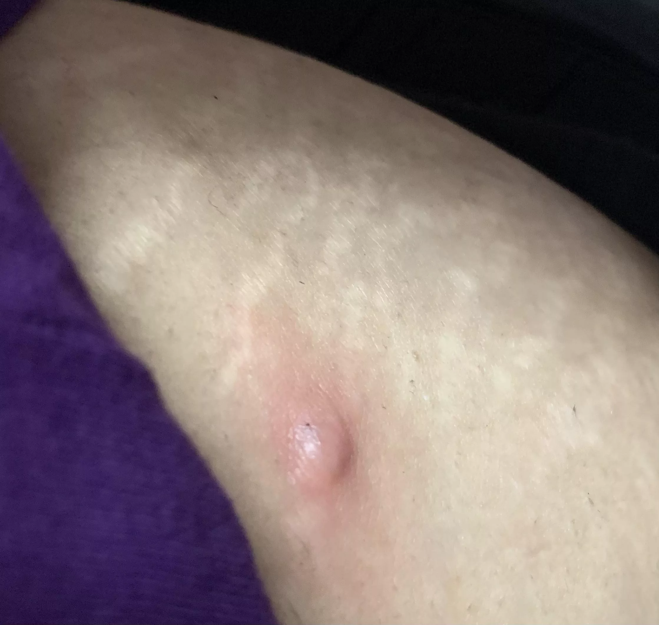 Noticed this weird looking thing on my hip today. Hurts when you press it. Don’t know what it is.