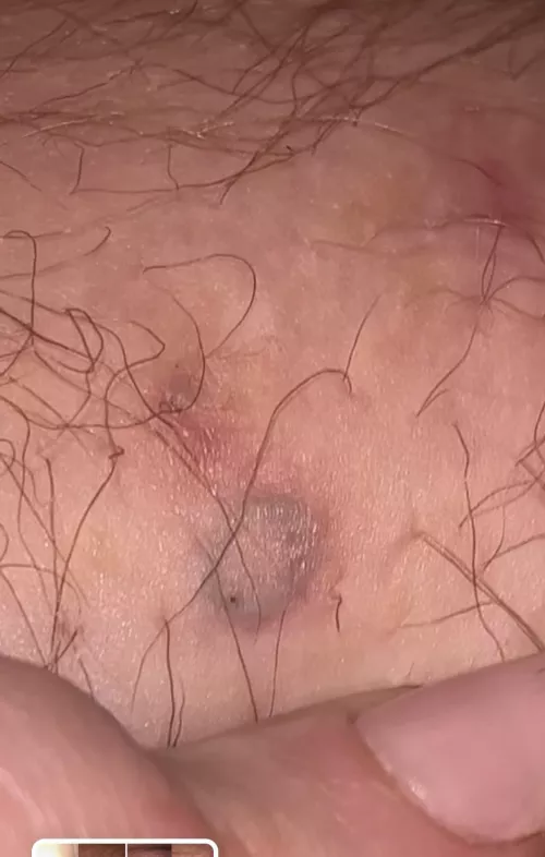 okay here’s the repost of my ingrown hair coil that i have yet to remove 🫠 (i’ll upload video when i actual do remove it)