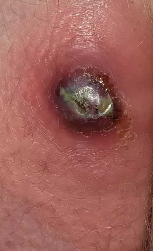 Pilonidal Cyst I just had drained. worst pain I've ever felt