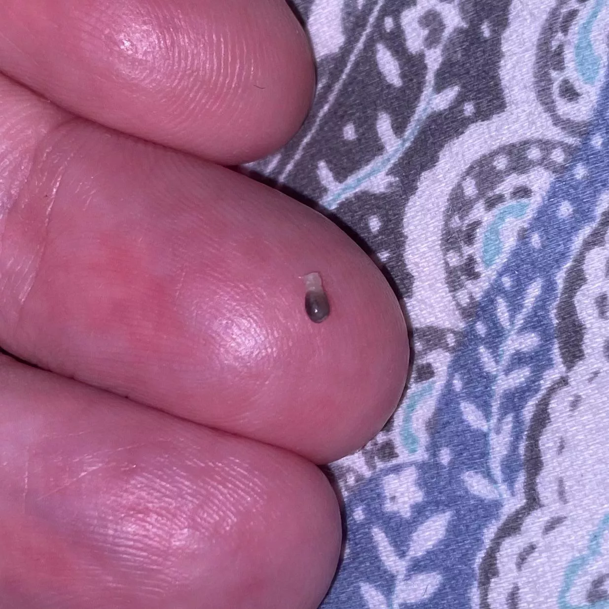 Popped this weird pellet out of an angry pimple on the back of my thigh Popped this weird pellet out of an angry pimple on the back of my thigh