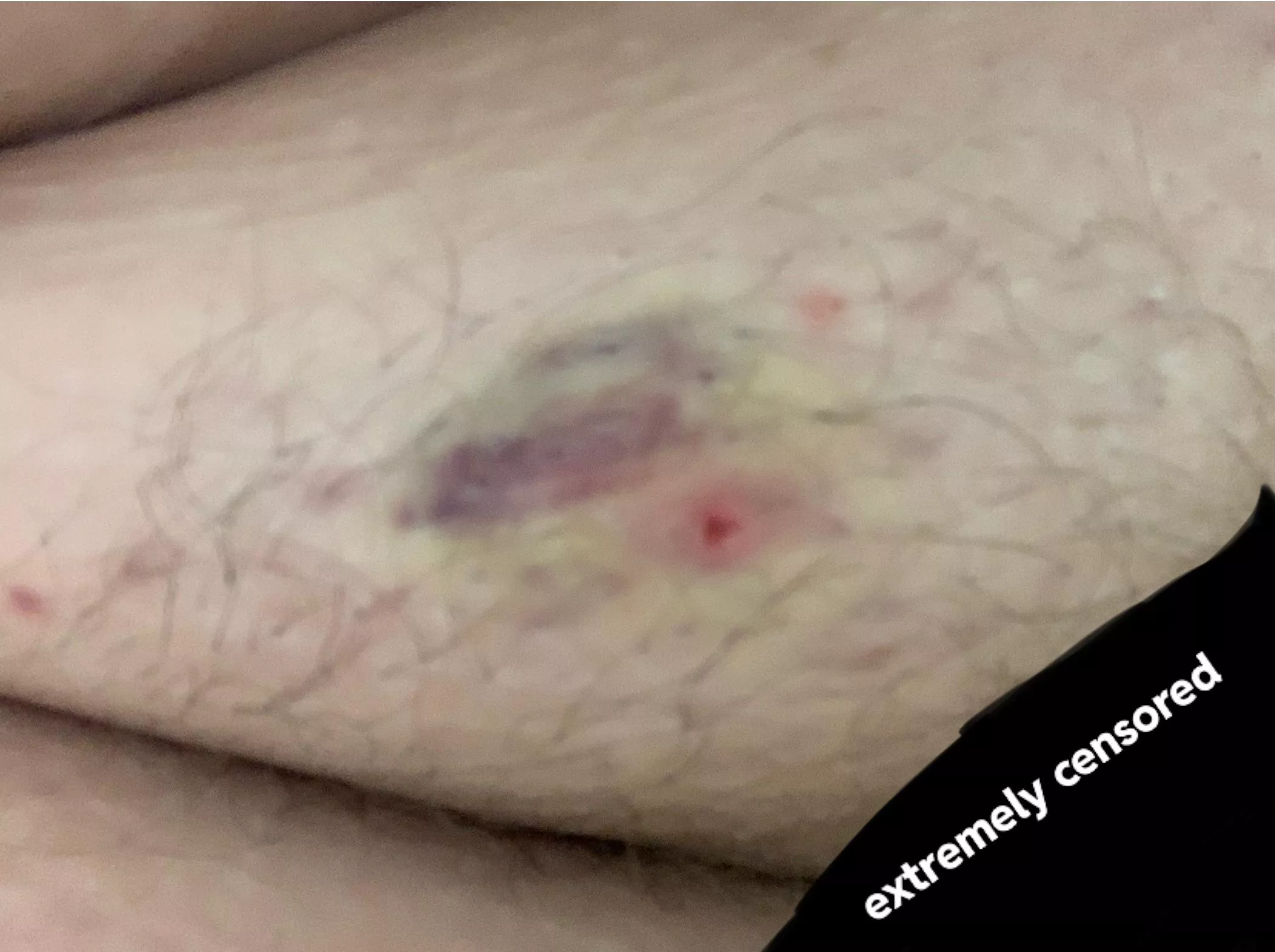Poppers, beware! Had an ingrown hair on my coochie and apparently I squeezed too hard. Bruised, hurts to walk, extremely irritating. Be nice to your bodies, friends. NSFW even though you can’t see much.