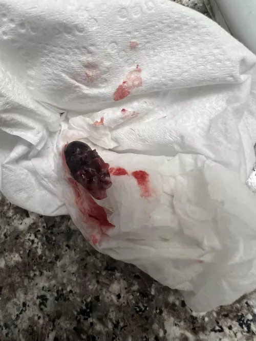 Pretty sure the cause to my hearing problems in my left ear was this bug I scooped out of my ear..and not ear wax